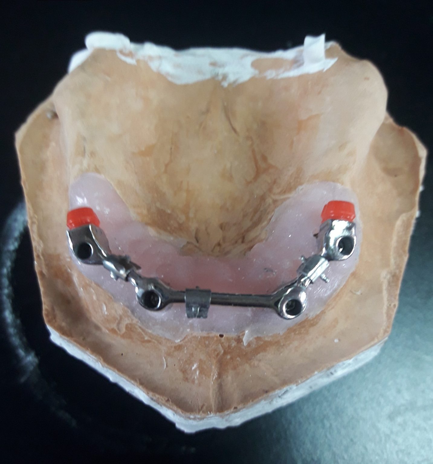 Prótesis removible sobre implantes - Laboratorio dental Vicky Heredero